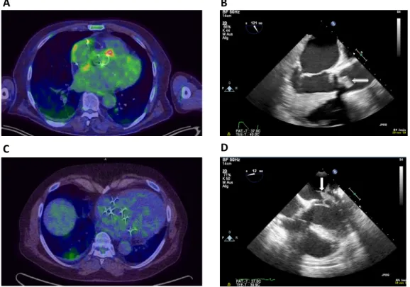 Figure 2. Exemplary FDG PET/CT scans and echocardiographic images illustrating the according endocarditic lesion are presented in this figure for a patient with a true-positive test result (A and B) and for a patient with a false-negative test result (C an