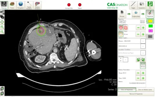 Figure 2.  Planning of ablation and simulation of the ablation defect in patients with malignant liver tumors