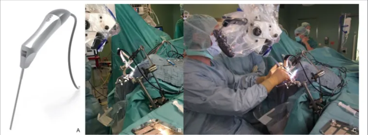 FIGURE 1 | QEVO ® micro-inspection tool (A) and setup in the operating theater, (B) mounted self-constructed endoscope-holder, (C) simultaneous visualization with the surgical microscope KINEVO ® and QEVO ® during microsurgical dissection.