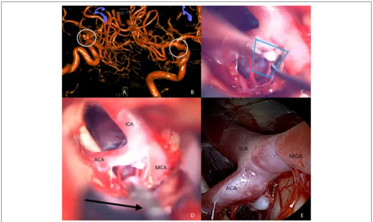 FIGURE 3 | Anatomical overview, case II (A,B) 3D angiography of a right ACA aneurysm, (C) dissection of aneurysm/microscope, (D) insertion of QEVO ® endoscope (black arrow)/microscope, (E) ICA and ACA from below with adjacent perforators/endoscope