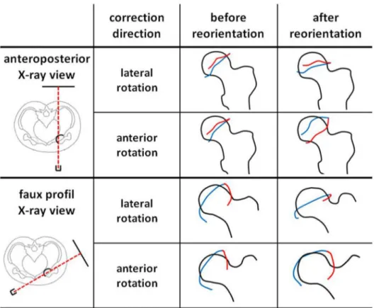 Fig. 2    Analysis of correction  directions (lateral rotation  and anterior rotation) under  anteroposterior (above) and  faux profil (below) X-ray view