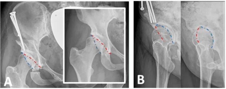 Fig. 3    Pre and postoperative X-ray of a female dysplasia following periacetabular osteotomy in anteroposterior view (a) and faux profile view  (b)