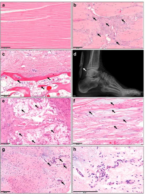 Figure 2. Histopathological changes in tendinopathy. (a) Normal tendon tissue, (b) fiber crimping and kinking, loosening of collagenous matrix, (c) increased proteoglycan (PG)/glycosaminoglycan (GAG) production and changed cytokine profiles, (d) hypercellu