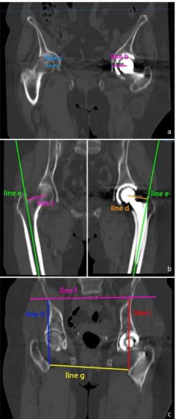 Figure 2. (a) Measurement of the acetabular offset in the coronar plane. Acetabular offset was defined as the  shortest distance from the center of the femoral head to the bottom of the acetabulum