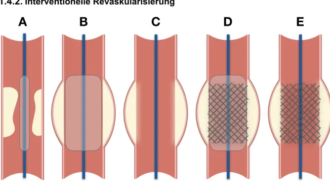 Abbildung 4 – Ballonangioplastie mit Stentimplantation, schematisch.  