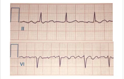 Abbildung  1.1  EKG-Dokumentation  von  Vorhofflimmern:  keine  erkennbaren               P-Wellen