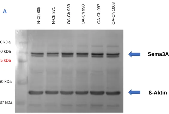 Abbildung 13A. Western Blot für Sema3A mit Proteinlysaten von Chondrozyten von Patienten mit und  ohne Gonarthrose aus 2D-Kultur