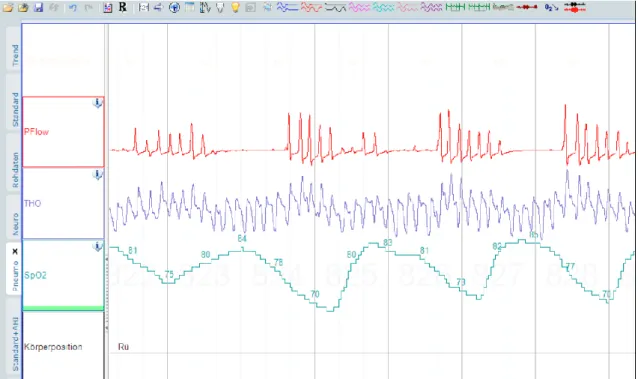 Abbildung 1: Obstruktive Schlafapnoe: Die rote Kurve (PFlow) zeigt den Atemfluss, die  blaue  Kurve  (THO)  die  Thoraxexkursion  und  die  grüne  Kurve  (SpO2)  die  Sauerstoffsättigung des Blutes