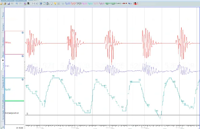 Abbildung  2:  zentrale  Schlafapnoe:  Die  rote  Kurve  (PFlow)  zeigt  den  Atemfluss,  die  blaue  Kurve  (THO)  die  Thoraxexkursion  und  die  grüne  Kurve  (SpO2)  die  Sauerstoffsättigung des Blutes
