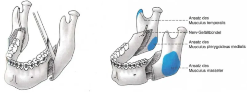 Abbildung 2: Schematische Darstellung einer retromolaren sagittalen Osteotomie des Unterkiefers beidseits nach  Obwegeser, in der Modifikation nach Hunsuck/Epker (Hoffmeister, 2007) 