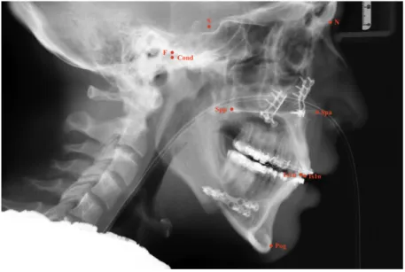 Abbildung 5: Anatomische Punkte im FRS am Beispiel eines postoperativen FRS 