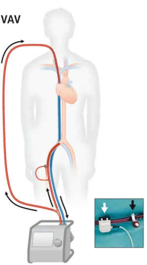 Abbildung 4: Veno-arterio-venöse ECMO (24) 