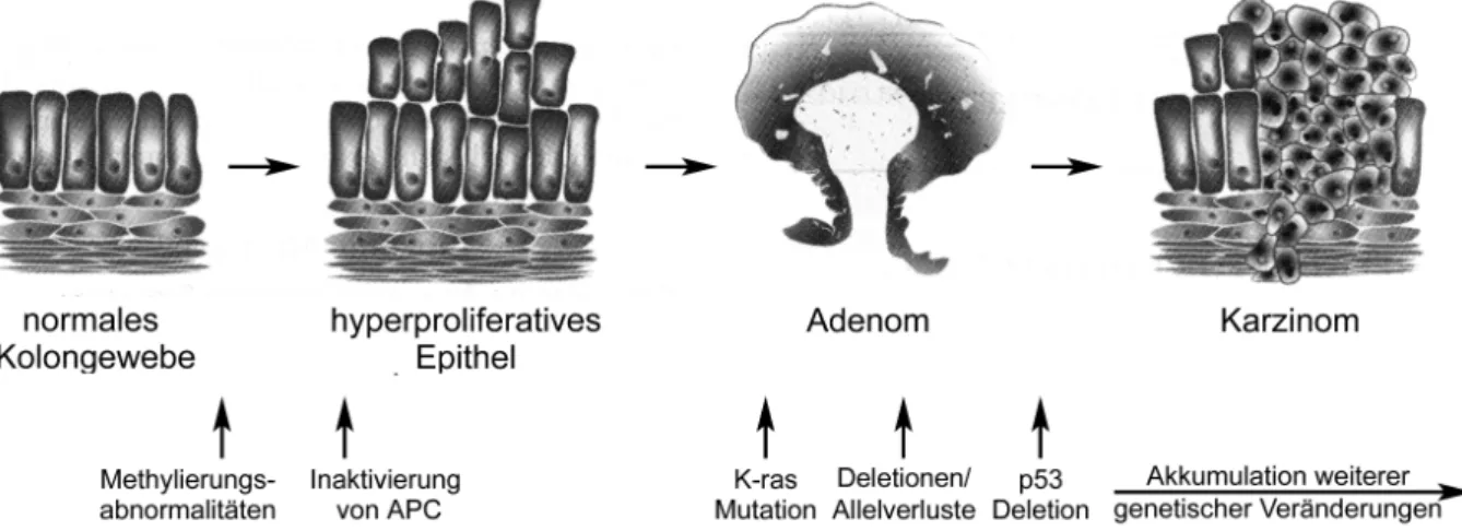 Abbildung 3: Adenom-Karzinom- Sequenz nach Morson et al. und Fearon und Vogelstein 