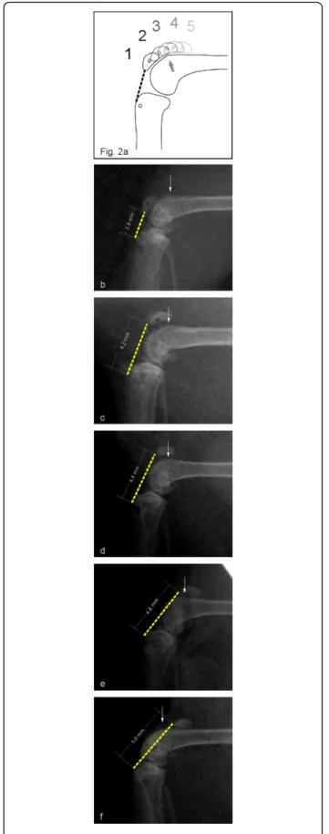 Fig. 2 a Scheme of the patellar bone position (PBP) grading system: