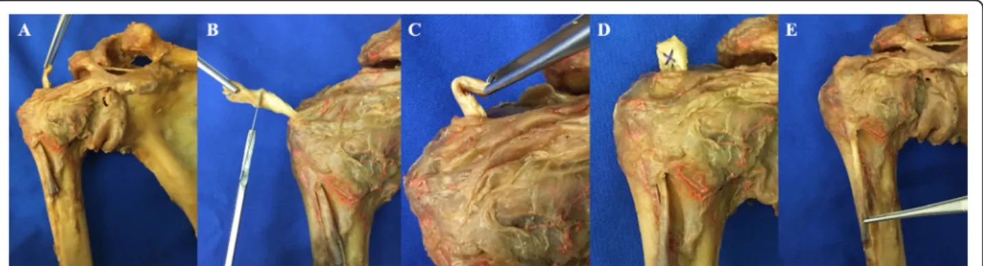 Fig. 2 Novel loop tenodesis: a) Long biceps tendon (LHB) pulled extraarticularly after tenotomy close to its base; b) Resection of the proximal part of the LHB; c) Tendon loop; d) Suturing the tendon loop; e) Autotenodesis of the LHB
