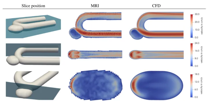 Fig. 2: Comparison of MRI measurement and CFD simulation for three different slices of the benchmark geometry.