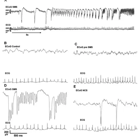 Figure 1 Sample ECoG and ECG traces of control and ictal conditions. Example of progression of a seizure with motor signs (SMS), which begins with spike-and-wave discharges, which increase in frequency and then become accompanied by high frequency ictal di