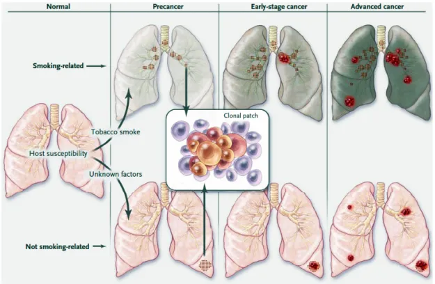 Figure 1: Evolution of lung cancer 