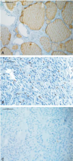 FIGURE 1  Examples of CD3 immunohistochemistry are  shown for normal thyroid tissue (A), ATC with numerous positive  lymphocytes (B) and FTC with only one positive lymphocyte (C)