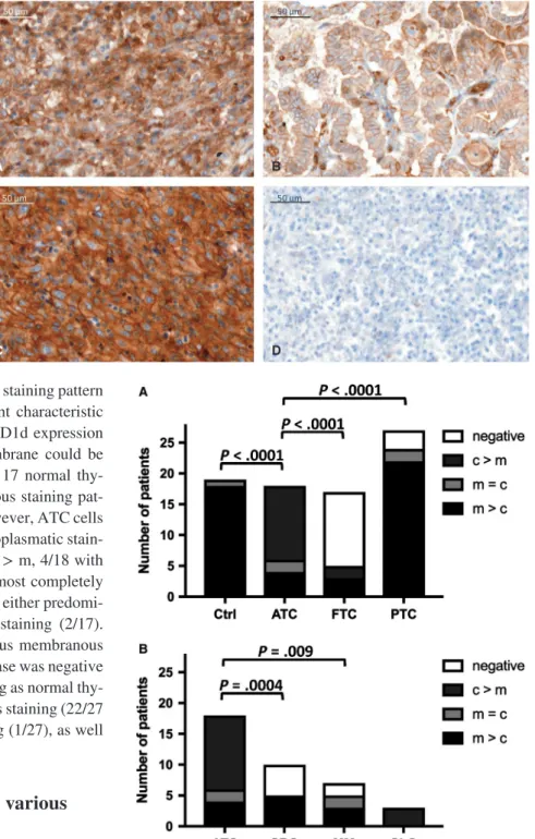 FIGURE 5  Staining patterns of normal thyroid tissue and  different thyroid cancer types (ATC: anaplastic thyroid carcinoma; 