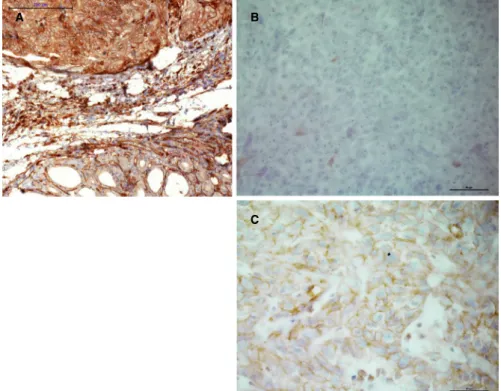 FIGURE 6  Expression of UBC (positive control) and DapB (negative control) with red chromogenic ISH (RNAscope) in a representative  ATC (A and B) and normal thyroid tissue (C and D)