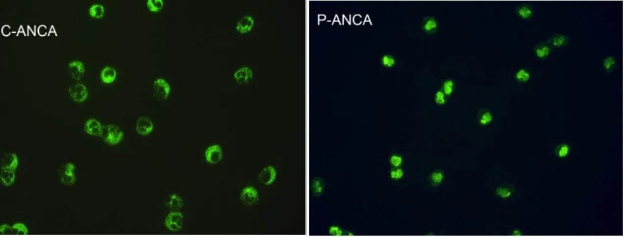 Abbildung 1: c-ANCA und p-ANCA in Etanolfixierung 