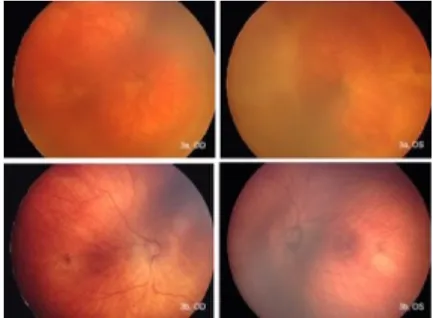 Abbildung 3: Weitwinkel-Fundus Bilder eines Kindes mit RPM in posteriorer Zone I   2