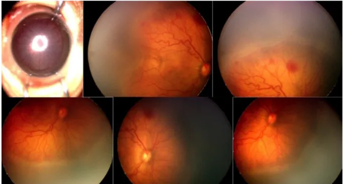 Abbildung 4: Rechtes Auge vor Laserkoagulation 