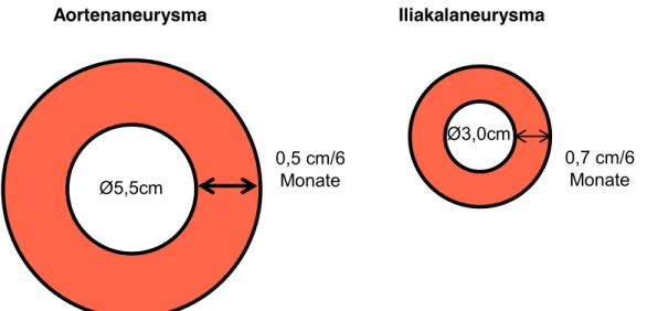 Abbildung 4: Durchmesser und Expansionsraten für Aorten- bzw. Iliakalaneurysmata, ab denen eine Therapie  indiziert ist