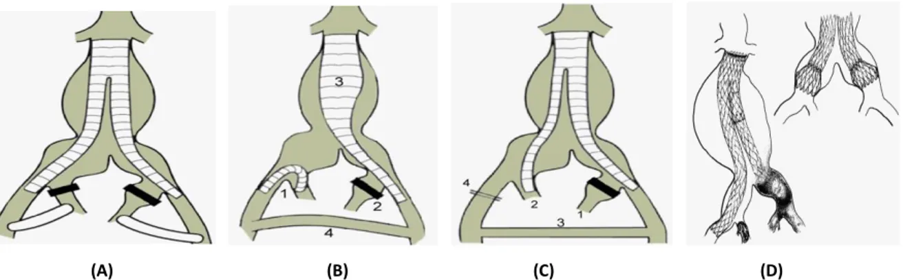 Abbildung  7:  Techniken  zum  Erhalt  des  anterograden  Blutflusses  der  AII:  (A):  Zweizeitiges  Bridging;  (B): 