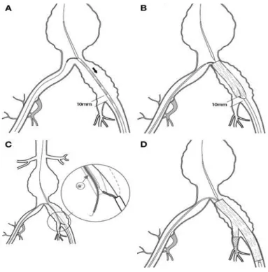 Abbildung 13: Verschiedene Schritte der Implantation des  Zenith® Branch Iliac Graft (Quelle: (69)) 