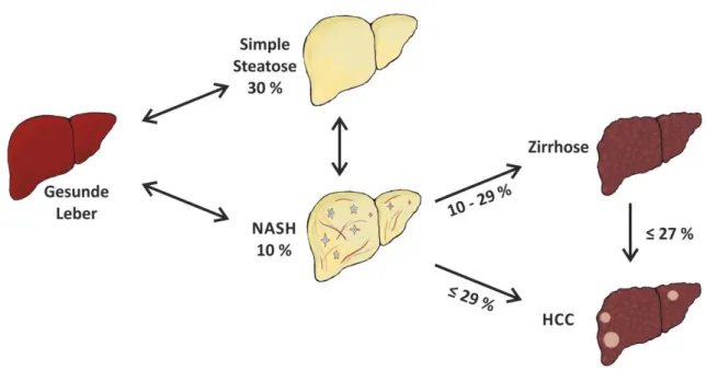 Abbildung 1: Schematische Darstellung der Progression der NAFLD zum HCC. Das erste Stadium der NAFLD  ist die Steatose, die durch die  Akkumulation  von Triglyzeriden  und weiteren Lipiden  in den  Hepatozyten  charakterisiert ist