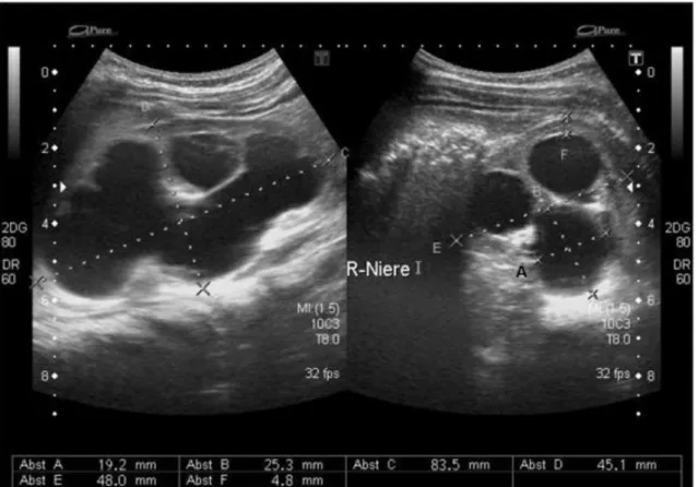 Abbildung 1. Ultraschallaufnahmen: HN bei UAE der rechten Niere, 18 Monate alte  Patientin