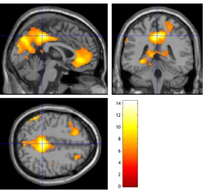 Figure 13:  Left posterior cingulate gyrus (0 -40 44), T: 14.40, KE: 2376; Peak activation (global maxima) in  MDD  patients  before  treatment  during  the  presentation  of  happy  facial  pictures  compared  to  baseline