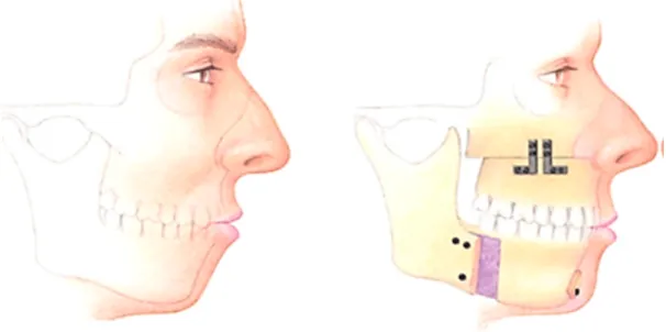 Abb. 3. Schematische Darstellung einer maxillo-mandibulären Umstellungsosteotomie   (aus Won et al., 2008) 