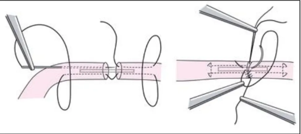 Abbildung 3: Schematische Darstellung der Kirchmayr-Kessler-Rahmennaht einer Sehne  III Dabei wird dorsomedial ein ca