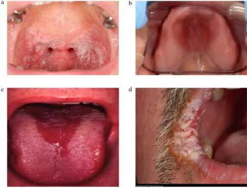 Abb.  1  Die  vier  Formen  der  oralen  Candidose:  akute  pseudomembranöse  Candidose  (a),  chronische  erythematöse  Candidose (b), akute erythematöse Candidose (c), chronische hyperplastische Candidose (d) [27] 
