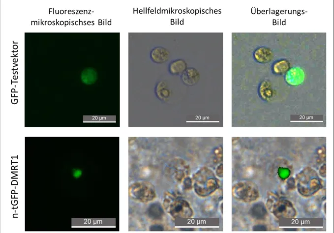Abb. 3-14: Darstellung transfizierter THP-1 Zellen mit fluoreszierendem Testvektor im  Zytoplasma (oben) und n-tGFP-DMRT1 im Zellkern der THP-1 Zelle (unten) 