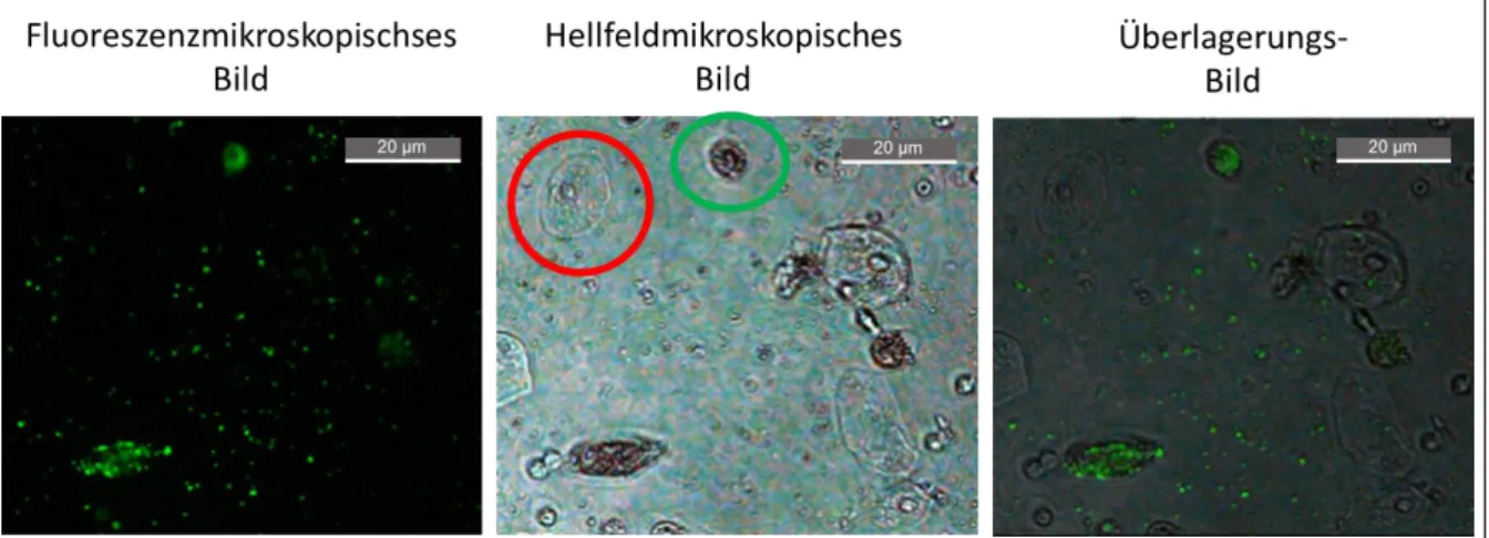 Abb. 4-3:   Epithelzelle (rote Markierung) und Phagozyt (grüne Markierung) in mit  fluoreszierenden Microspheres versehenem induziertem Sputum 