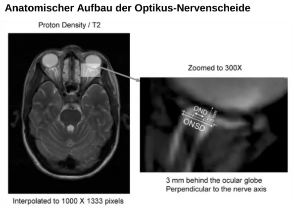 Abbildung 2: Lage, Aussehen und Messung der Optikus-Nervenscheide 4    