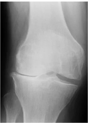 Abbildung 4: Röntgenbild einer lateralen Gonarthrose [7] 