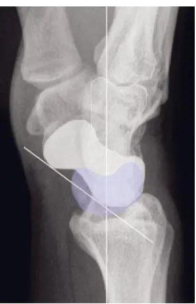 Abbildung 4: DISI-Position im  seitlichen Röntgenbild (SL-Winkel       
