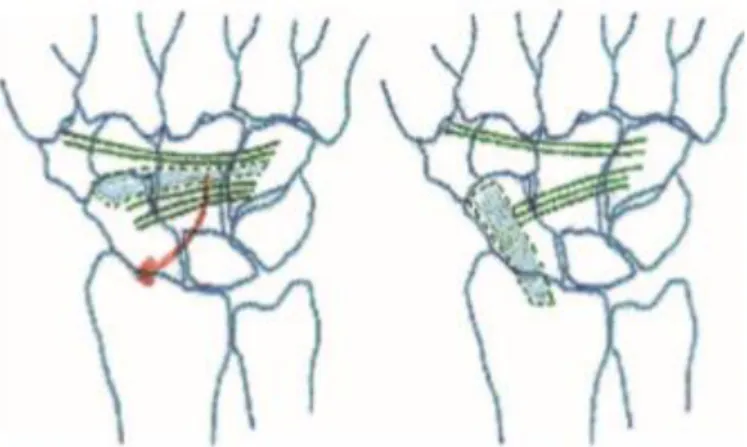 Abbildung 6: Das Ligamentum intercarpale dorsale wird umgelagert. 