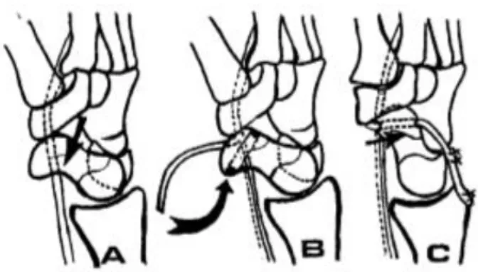 Abbildung 12: Operation nach Brunelli: Flexionsstellung des Scaphoids (A),  Reposition von Scaphoid und Lunatum, FCR-Sehnenzug durch den distalen  Pol des Scaphoids von palmar nach dorsal (B), Fixieren der FCR-Sehne (C)