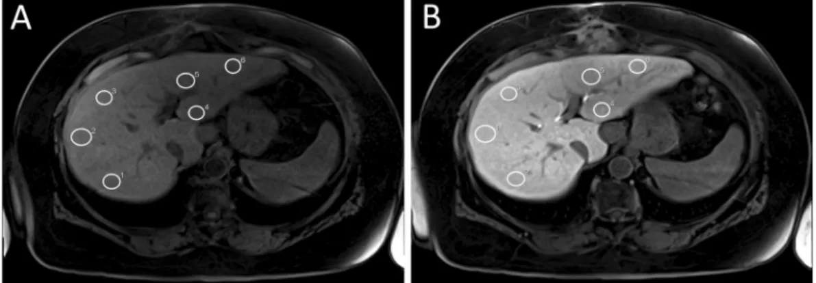 Figure 4.  Representative example of ROI placement in unenhanced (A) and Gd-EOB-DTPA-enhanced VIBE  (B) scans of a patient with normal liver function