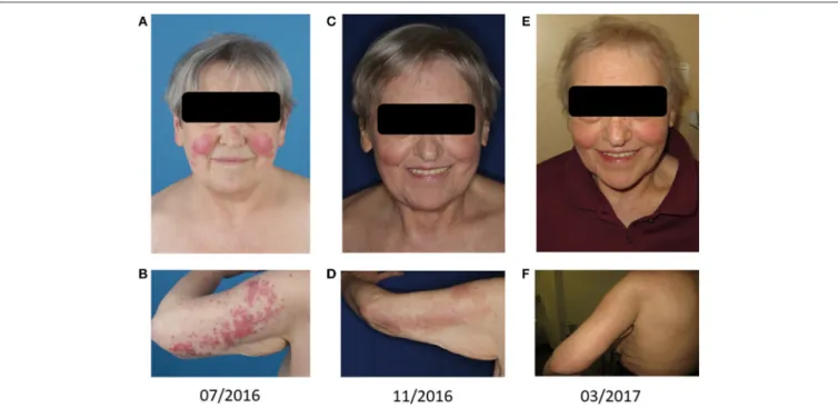 FIGURE 1 | Cutaneous leukemic skin infiltrates: Skin lesions on the face (A,C,E) and the back of the left upper arm (B,D,F) are shown