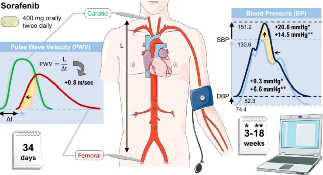Figure 2. Effects of sorafenib on vascular stiffness. Patients treated with sorafenib showed an increase  in systolic blood pressure (SBP) and diastolic blood pressure (DBP) as well as an elevation of the pulse  wave velocity (both indicated by yellow area