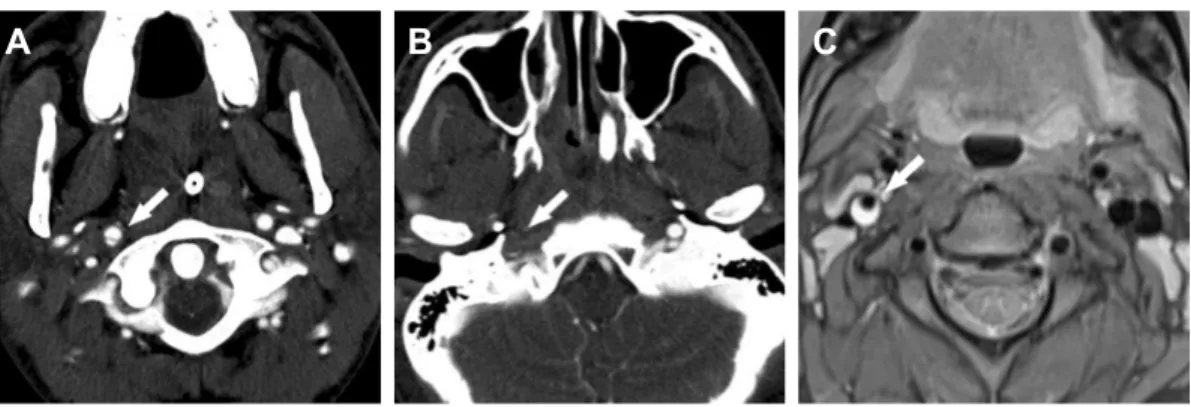 Figure 4 image of traumatic carotid artery dissection on the right side.
