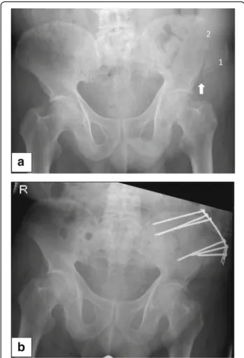 Fig. 1 a Fatigue fracture of the ASIS following bone graft harvesting at the anterior iliac crest