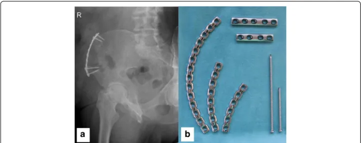 Fig. 6 a X-ray (right pelvis ala-view) of a 73-year-old patient 8 years after bone harvesting (vascularized iliac crest) and simultaneous plate osteo- osteo-synthesis to prevent a fatigue fracture